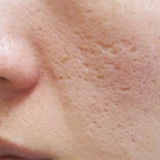 毛穴の開き・ニキビ跡の凹凸を改善したい