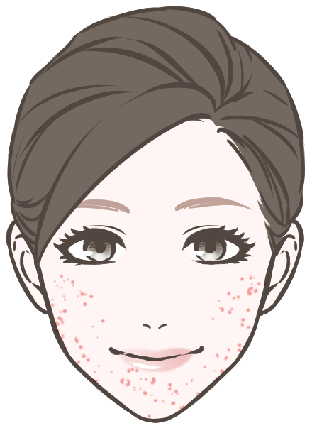 消えないニキビ跡(色素沈着)に悩んでいる