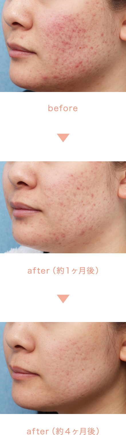 before/after（約１ヶ月後）/after（約４ヶ月後）