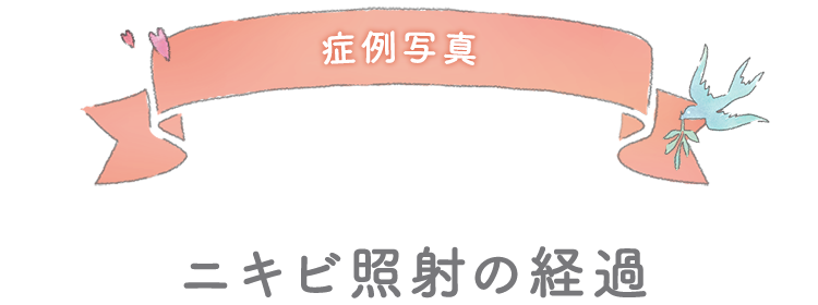 症例写真 ニキビ照射の経過