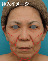 挿入イメージ