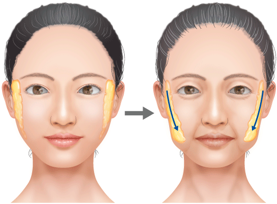 バッカルファットは年齢とともに下垂していきます。