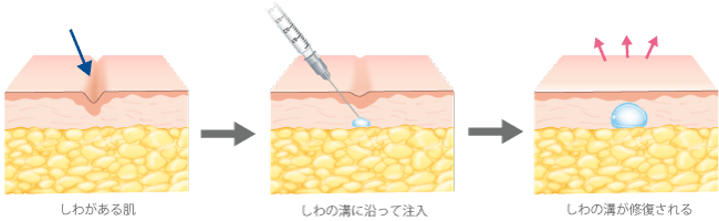 しわがある肌→しわの溝に沿って注入→しわの溝が修復