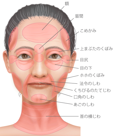 額　眉間　上まぶたのくぼみ　目尻　目の下　こめかみ法令のしわ　ホホのくぼみ　くちびるのたてじわ　口角のしわ　あごのしわ