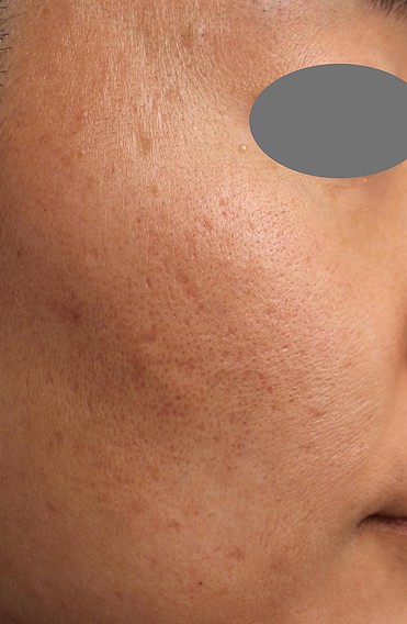 ヴァンパイアフェイシャルPRP治療前