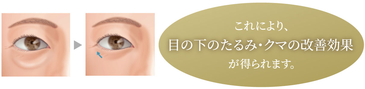 これにより、目の下のたるみ・クマの改善効果が得られます。