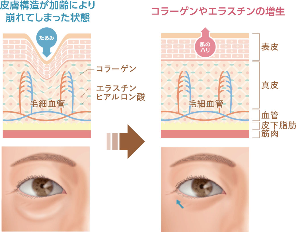 皮膚構造が加齢により崩れてしまった状態／コラーゲンやエラスチンの増生
