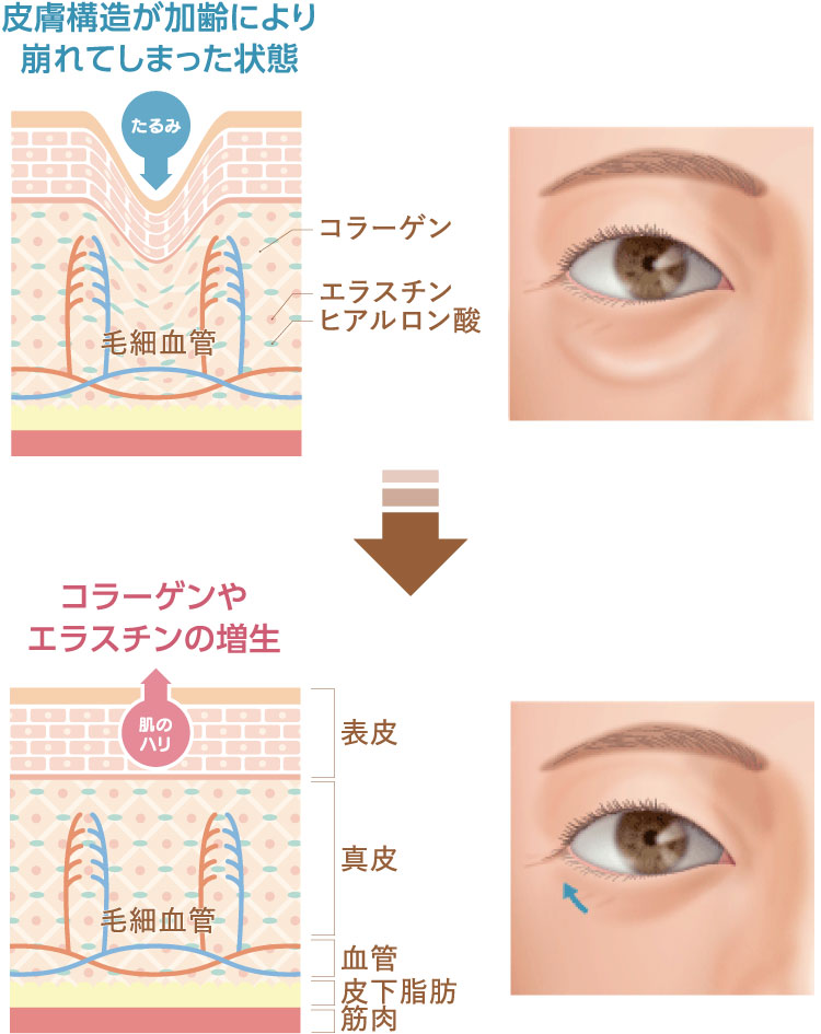 皮膚構造が加齢により崩れてしまった状態／コラーゲンやエラスチンの増生