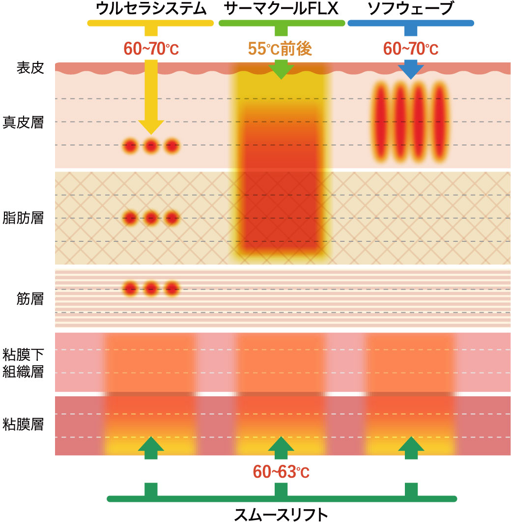 ウルセラシステム、サーマクールFLX、ソフウェーブ、スムースリフトの照射エリア、効果のあるお肌の層の比較