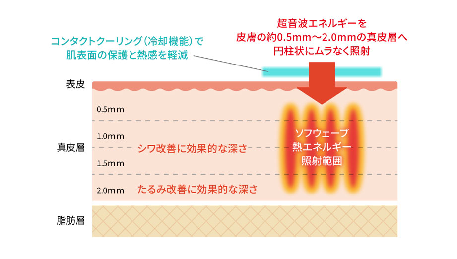 コンタクトクーリング（冷却機能）で
				肌表面の保護と熱感を軽減/超音波エネルギーを皮膚の約0.5mm～2.0mmの真皮層へ円柱状にムラなく照射