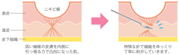 サブシジョン＋ジュベルック治療
