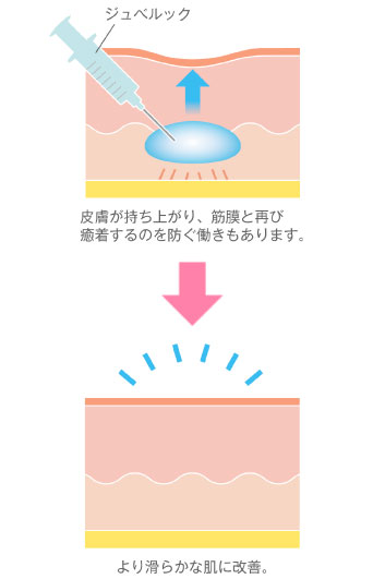 サブシジョン＋ジュベルック治療