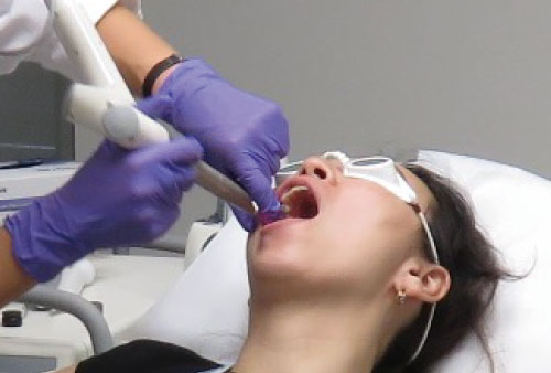 口腔内からの照射による深部アプローチ