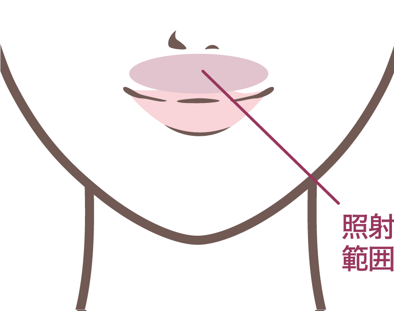 人中短縮フォトナレーザーの場合、鼻下･口腔内粘膜を照射します。