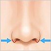 鼻翼縮小（小鼻縮小）