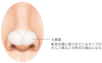 大鼻翼/軟骨が横に張り出ているタイプのだんご鼻はこの術式の適応になる