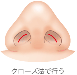 クローズ法で行う