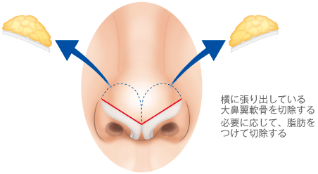 横に張り出している大鼻翼軟骨を切除する/必要に応じて、脂肪をつけて切除する