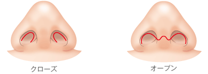 クローズ法かオープン法で行う