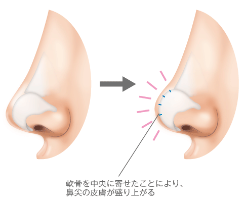 軟骨を中央に寄せたことにより、鼻尖の皮膚が盛り上がる