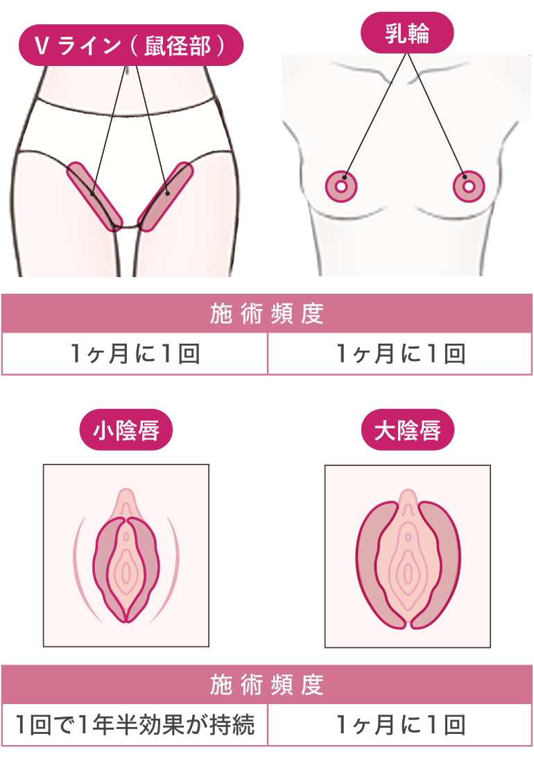 Vライン（鼠径部） 施術頻度：1ヶ月に1回/乳輪 施術頻度：1ヶ月に1回/小陰唇 施術頻度：1回で1年半効果が持続/大陰唇 施術頻度：1ヶ月に1回