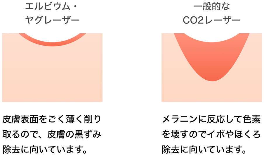 エルビウム・ヤグレーザー：皮膚表面をごく薄く削り取るので、皮膚の黒ずみ除去に向いています。/一般的なCO2レーザー：メラニンに反応して色素を壊すのでイボやほくろ除去に向いています。