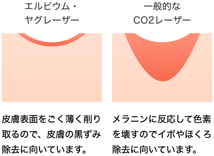 エルビウム・ヤグレーザー：皮膚表面をごく薄く削り取るので、皮膚の黒ずみ除去に向いています。/一般的なCO2レーザー：メラニンに反応して色素を壊すのでイボやほくろ除去に向いています。