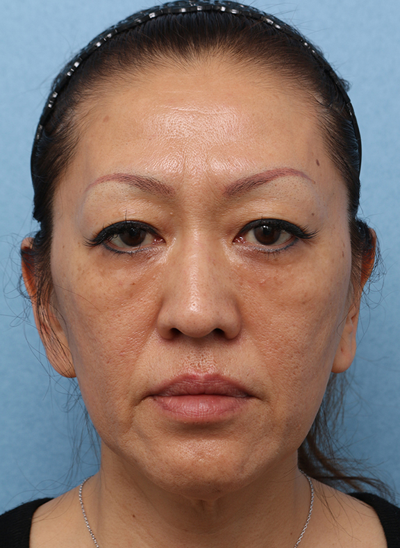 症例写真,Vシェイプリフト(ヒアルロン酸注射) 50代女性の症例写真,After(3ヶ月後),ba_v_shapelift013_b01.jpg
