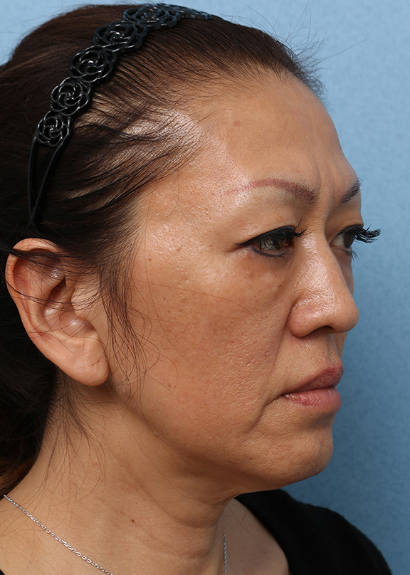 症例写真,Vシェイプリフト(ヒアルロン酸注射) 50代女性の症例写真,After(3ヶ月後),ba_v_shapelift013_b02.jpg