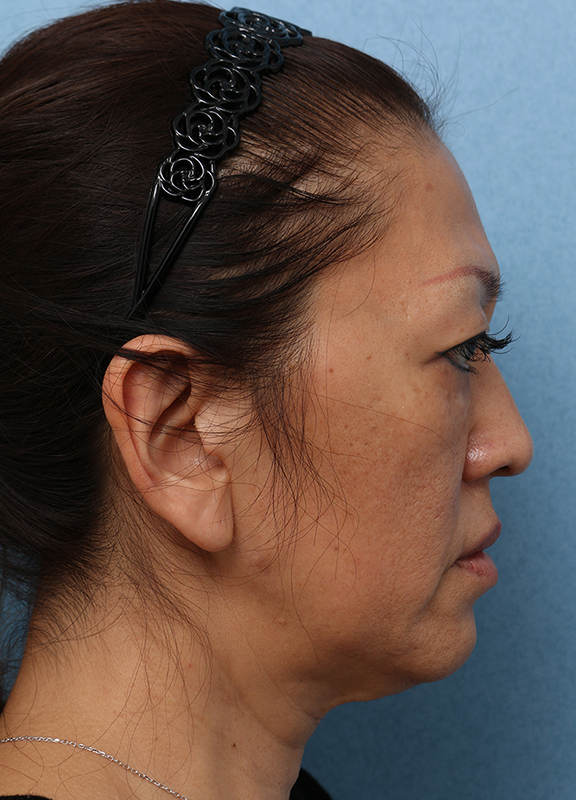 症例写真,Vシェイプリフト(ヒアルロン酸注射) 50代女性の症例写真,After(3ヶ月後),ba_v_shapelift013_b03.jpg