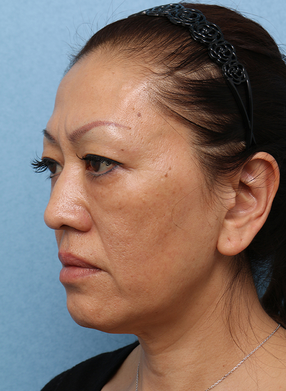 症例写真,Vシェイプリフト(ヒアルロン酸注射) 50代女性の症例写真,After(3ヶ月後),ba_v_shapelift013_b04.jpg