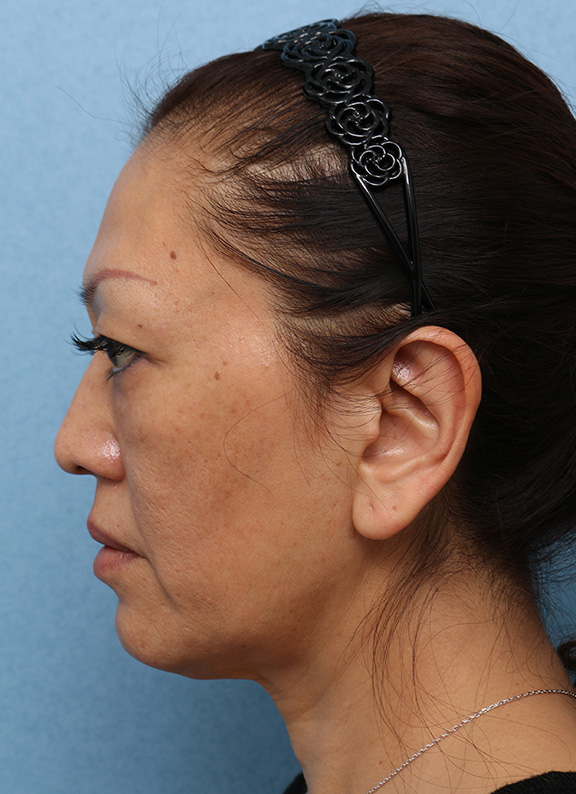 症例写真,Vシェイプリフト(ヒアルロン酸注射) 50代女性の症例写真,After(3ヶ月後),ba_v_shapelift013_b05.jpg