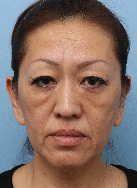 症例写真,Vシェイプリフト(ヒアルロン酸注射) 50代女性の症例写真,Before,ba_v_shapelift013_b01.jpg