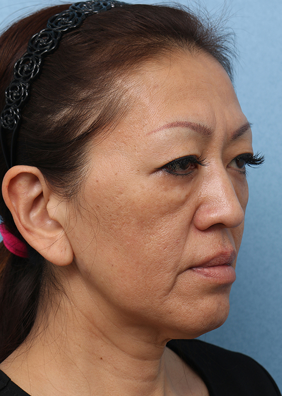 症例写真,Vシェイプリフト(ヒアルロン酸注射) 50代女性の症例写真,Before,ba_v_shapelift013_b02.jpg