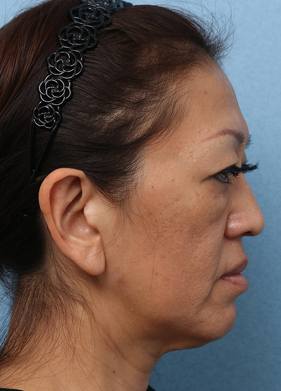 症例写真,Vシェイプリフト(ヒアルロン酸注射) 50代女性の症例写真,Before,ba_v_shapelift013_b03.jpg