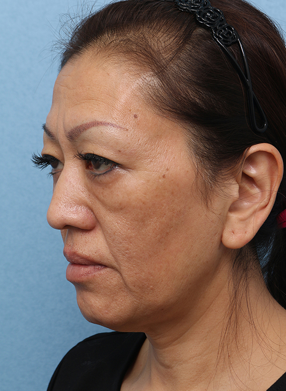 症例写真,Vシェイプリフト(ヒアルロン酸注射) 50代女性の症例写真,Before,ba_v_shapelift013_b04.jpg