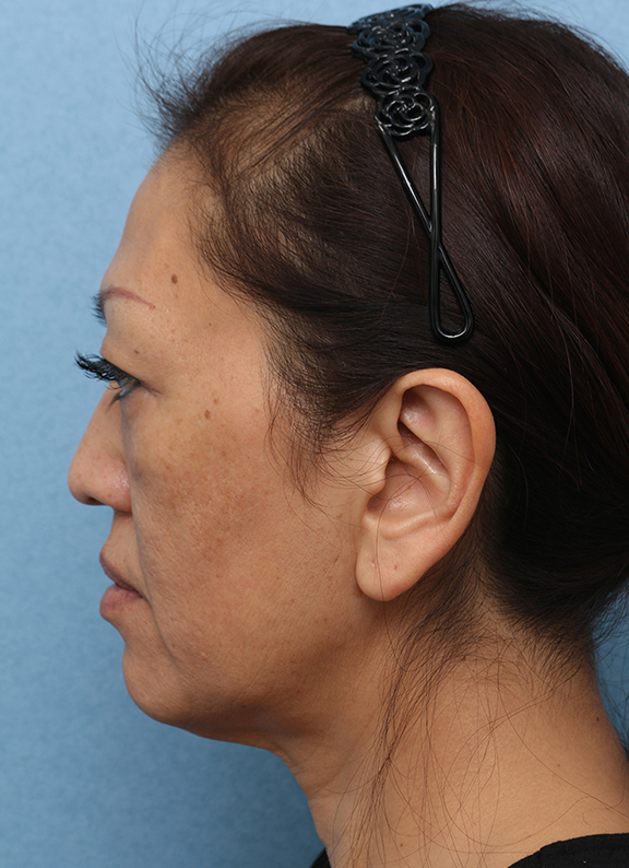 症例写真,Vシェイプリフト(ヒアルロン酸注射) 50代女性の症例写真,Before,ba_v_shapelift013_b05.jpg