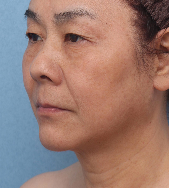 症例写真,イタリアンリフトの症例写真 たるみのご相談でこられた60代女性,After(6ヶ月後),ba_italian024_b03.jpg