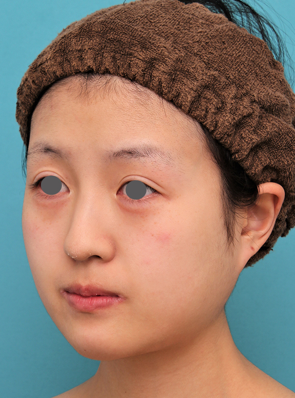 症例写真,20代女性の顎のシリコンプロテーゼの症例写真,After(6ヶ月後),ba_ago019_b02.jpg