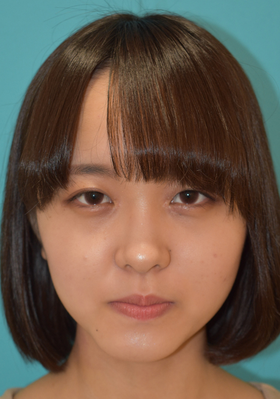 目頭切開,目頭切開の症例 目の間隔が広い事を気にされていた全顔モニターの女性,After(メイクあり),