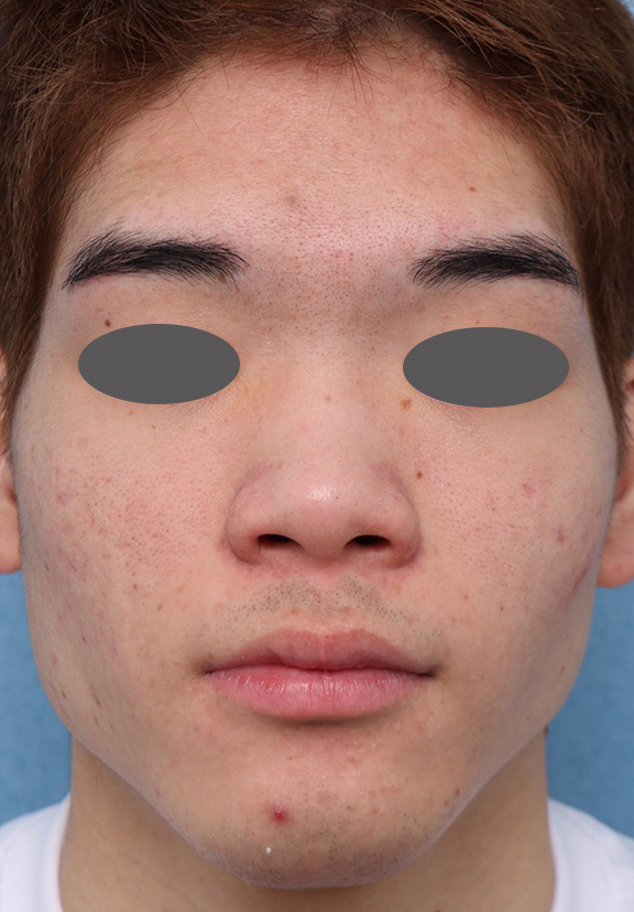 症例写真,ニキビ治療の症例写真 おでこ、両頬に赤いニキビが散在している男性,After(6ヶ月後),ba_ipl008_b01.jpg