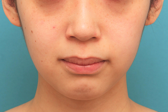 症例写真,ガミースマイルを手術で治した20代女性症例写真,After(2ヶ月後),ba_gammy004_b01.jpg