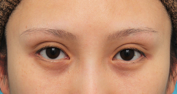 目頭切開,目尻切開,目頭切開+目尻切開で目の横幅を広げた症例写真,After（6ヶ月後）,ba_megashira061_a01.jpg
