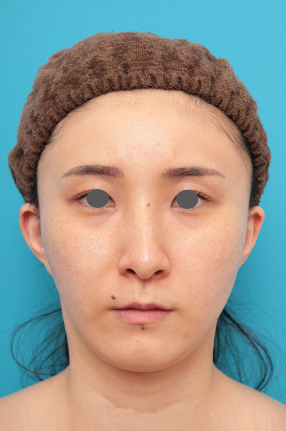 脂肪吸引（頬、あご下）,ミニフェイスリフト（頬のたるみ取り）,脂肪吸引,ミニフェイスリフト（頬のたるみ取り）・脂肪吸引（頬、あご下）の症例写真,After（6ヶ月後）,ba_minilift009_a01.jpg
