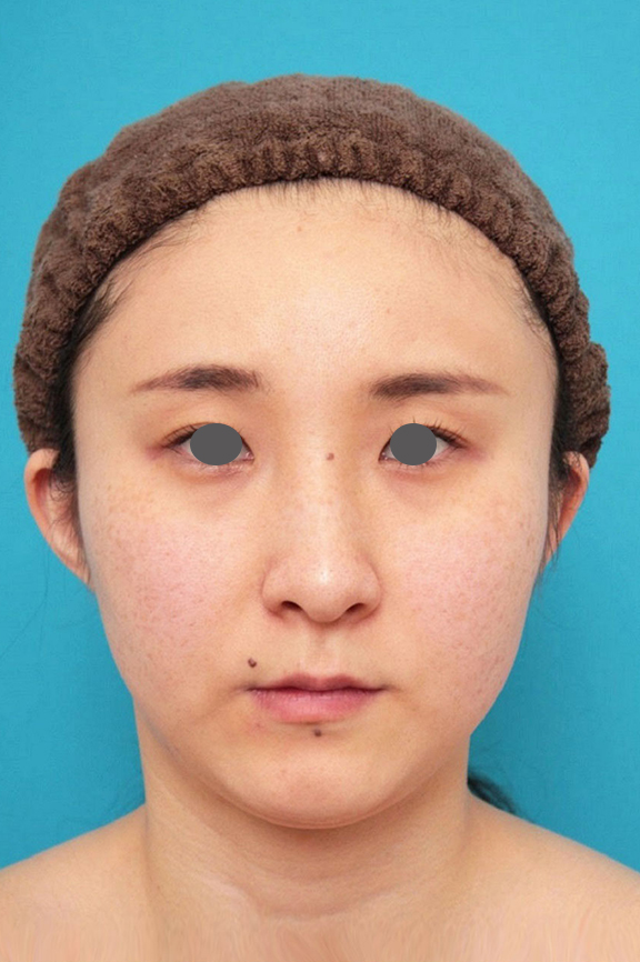脂肪吸引（頬、あご下）,ミニフェイスリフト（頬のたるみ取り）,脂肪吸引,ミニフェイスリフト（頬のたるみ取り）・脂肪吸引（頬、あご下）の症例写真,Before,ba_minilift009_b01.jpg