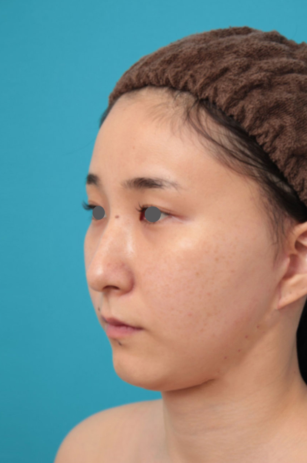 ミニフェイスリフト(頬のたるみ取り),ミニフェイスリフト(頬のたるみ取り)・脂肪吸引(頬、あご下)の症例写真,1ヶ月後,mainpic_minilift009g.jpg
