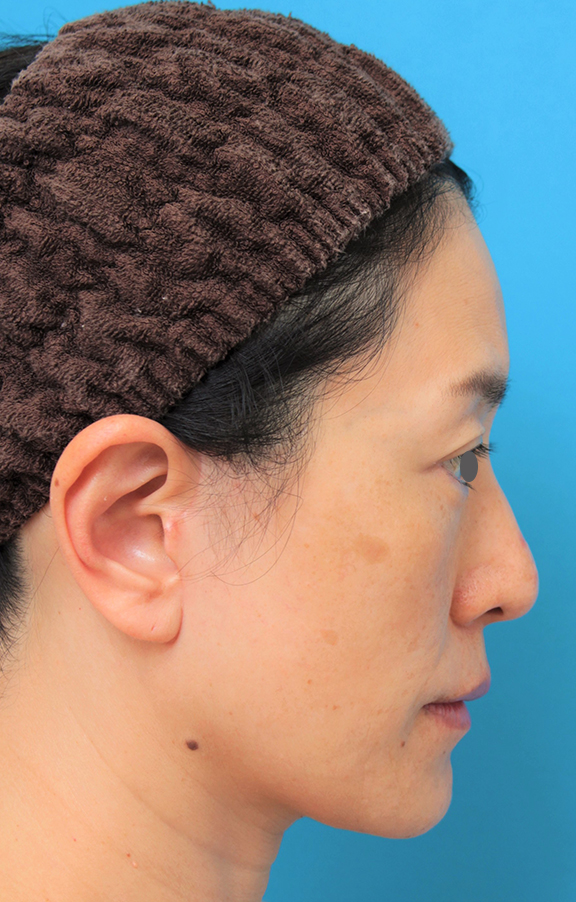 症例写真,40代後半女性のミディアムフェイスリフトの症例写真,After(6ヶ月後),ba_mediumlift011_b02.jpg