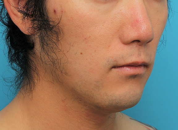 症例写真,リップリフト(人中短縮手術)を行った30代男性の症例写真,After(6ヶ月後),ba_hanashita004_b02.jpg