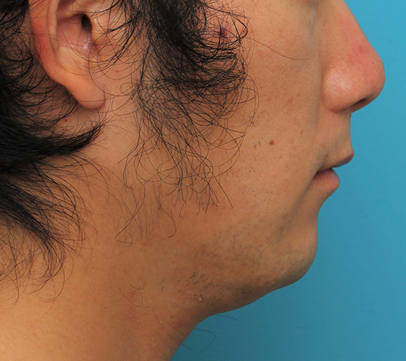 症例写真,リップリフト(人中短縮手術)を行った30代男性の症例写真,After(6ヶ月後),ba_hanashita004_b03.jpg