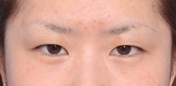 二重まぶた・埋没法,埋没法で平行型二重を作った症例写真,Before,ba_maibotsu38_b.jpg